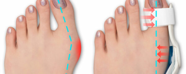 hallux valgus