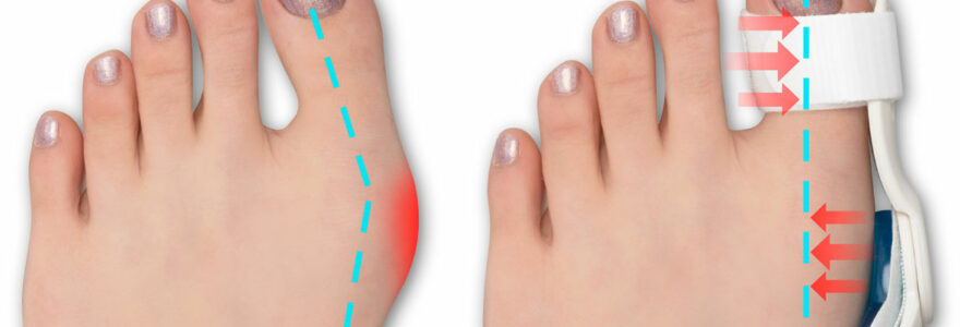 hallux valgus